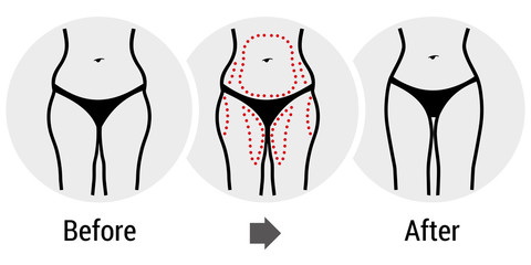 plastic surgery hips