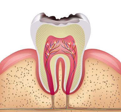 Tooth cross section with dental caries