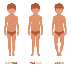 valgus, varus knee, legs disease, foot illustration