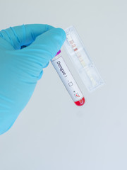 Dengue virus testing by using test cassette, the result showed positive (double red line)
