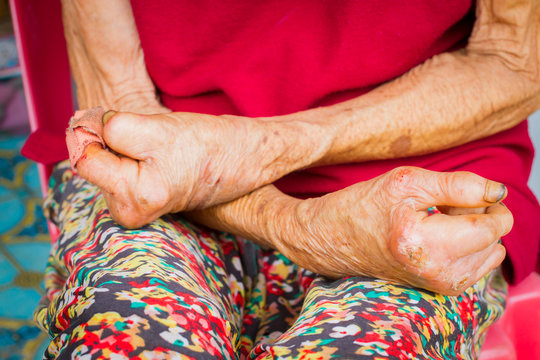 closeup hands of old woman suffering from leprosy, amputated hands, front view