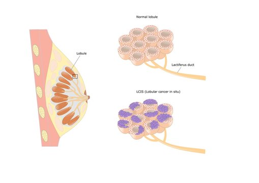 cancro lobulare del seno