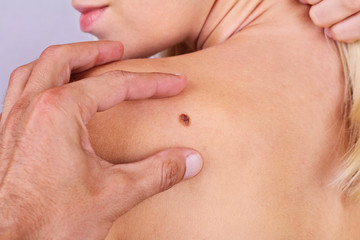 Doctor, dermatologist, hands examines a birthmark of patient. Checking benign moles