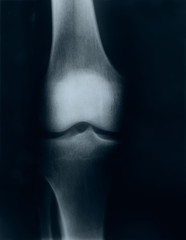 X-ray image of knee
