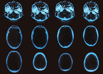 Computed tomography X-ray image