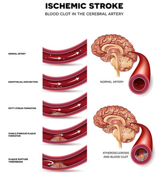 Blood Clot Formation In The Cerebral Artery