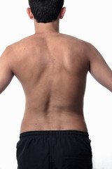 scoliosis, thin man on his back, no shirt. curvature of the spin