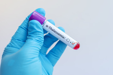 Fototapeta premium Alpha thalassemia blood sample