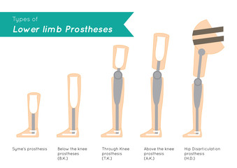 Types of Lower Limb Prosthetics infographic vector