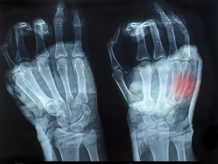 X-Ray image of human hands with top hand shown red