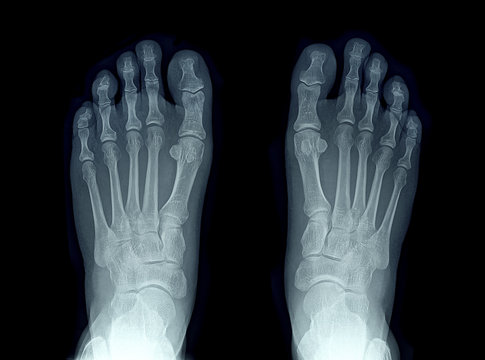 x-ray image of two feet