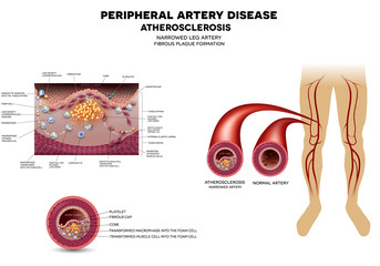 Leg artery disease, Atherosclerosis