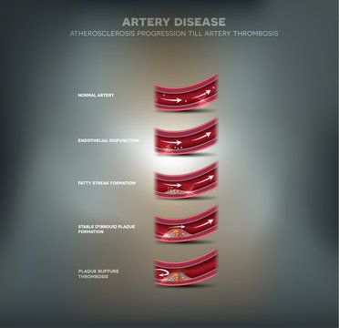 Artery Disease, Atherosclerosis Progression And Blood Clot