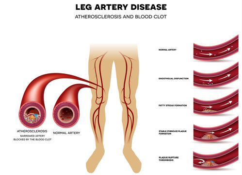 Leg artery disease, Atherosclerosis