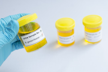 Urine sample positive with Neisseria gonorrhoeae bacteria
