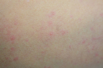 ill allergic rash dermatitis eczema skin of patient