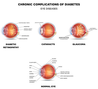 Diabetic Eye Diseases