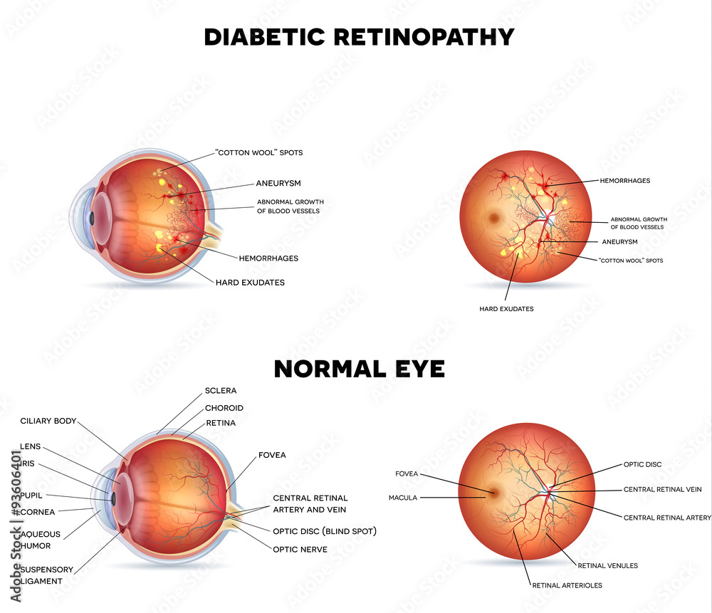 Sticker Diabetic retinopathy