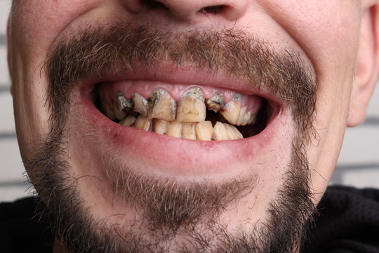 bad teeth