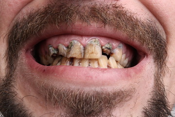 Bad teeth smoker sick