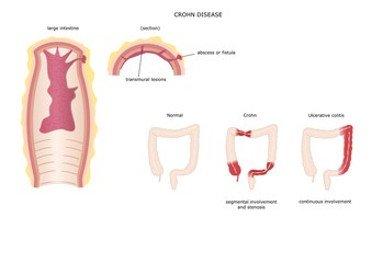 Morbo di Crohn, malattia autoimmune dell'intestino
