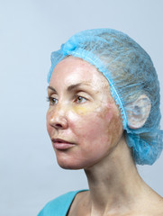 Cosmetology. New skin after a chemical peeling, a redness because of too fast deleting an old layer.