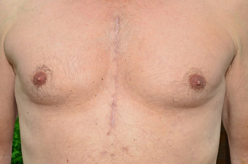 Male chest 6 months after open heart surgery