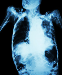 Pulmonary Tuberculosis with acute respiratory failure ( Film chest x-ray of old patient show...