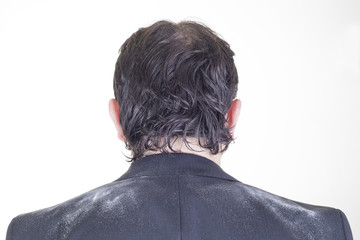 Hombre con caspa - dermatitis seborreica.