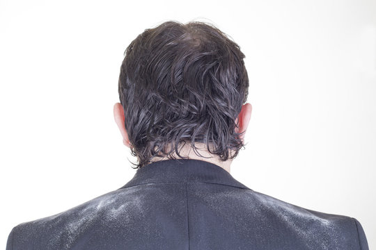 Hombre con caspa - dermatitis seborreica.