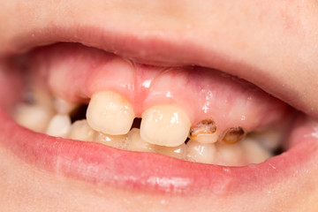 Naklejka premium baby teeth in the mouth