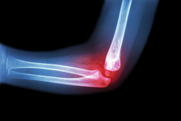 Rheumatoid arthritis , Gouty arthritis ( film x-ray child 's elbow with arthritis at elbow ) ( Side...