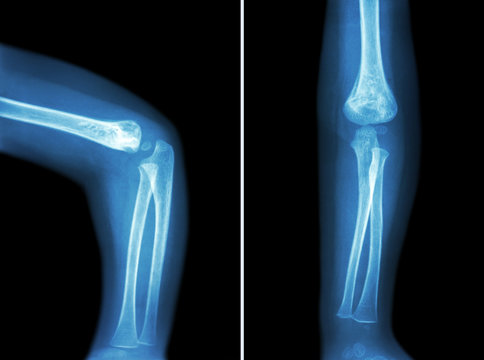 Film x-ray of child 's elbow ( normal child 's elbow ) ( Side and front view , Lateral and Anterior - Posterior view ) ( 2 position )