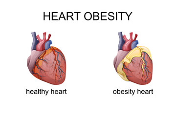 obesity heart