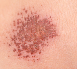 Fototapeta premium wound in human skin