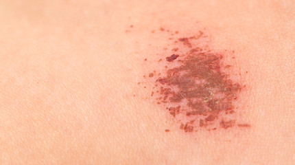wound in human skin