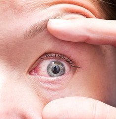 irritated eye