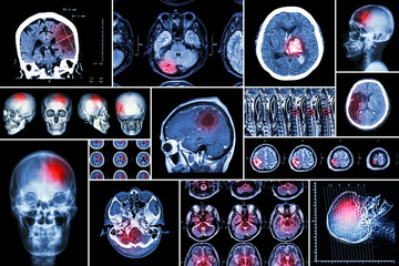 Set , Collection of brain disease ( Cerebral infarction , Hemorrhagic stroke , Brain tumor , Disc herniation with spinal cord compression ,etc)( CT scan , MRI , MRT )( Neurology and Nervous system )