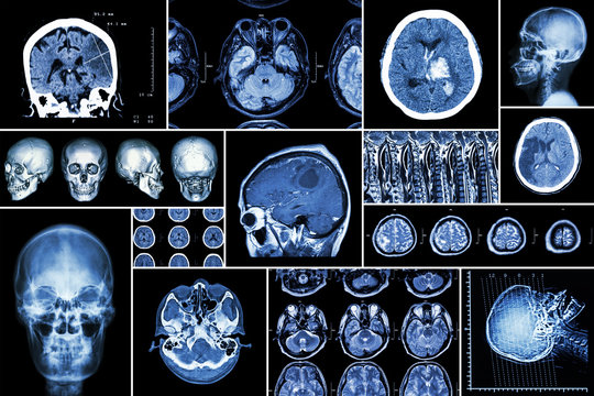 Set , Collection of brain disease ( Cerebral infarction , Hemorrhagic stroke , Brain tumor , Disc herniation with spinal cord compression ,etc)( CT scan , MRI , MRT )( Neurology and Nervous system )