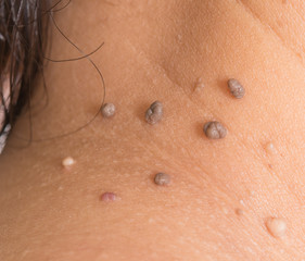skin of a woman with moles
