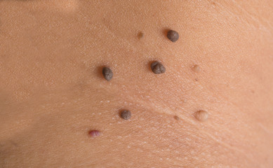 skin of a woman with moles