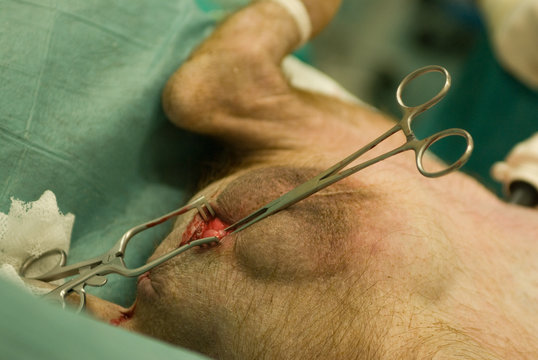 Cirujano colocando la aguja del suero en una operaci&oacute;n