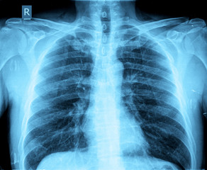xray of chest adult