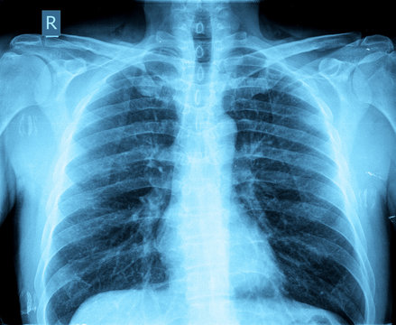 xray of chest adult