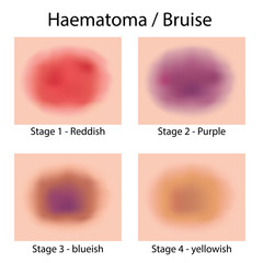 Illustration body with varying hematoma, bruise