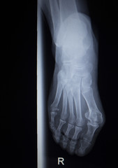 X-ray orthopedics scan of foot injury anterior posterior AP