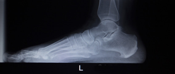 X-ray orthopedics scan of foot injury load weight bearing