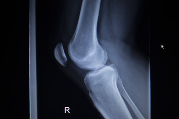 X-ray orthopedics scan of painful knee meniscus leg injury
