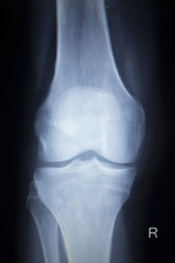 X-ray orthopedics scan of painful knee meniscus leg injury