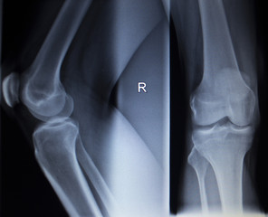 X-ray orthopedics scan of painful knee meniscus leg injury